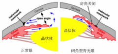 急性青光眼发作48小时内可致盲，我院已开启24小时急救通道
